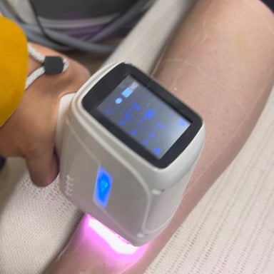 Forehead Laser hair Removal