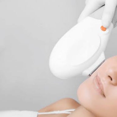 IPL Acne Treatment