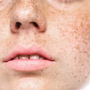 IPL Pigmentation/Frackle Removal