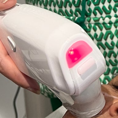 HIFU Double Chin reduction